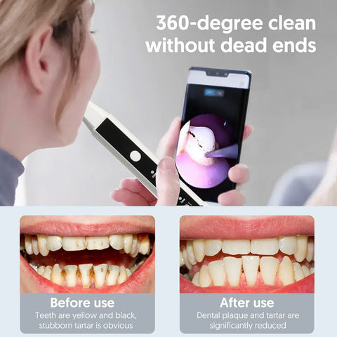 Intelligent Visual Ultrasonic Tooth Scaler Removal And Beauty Instrument